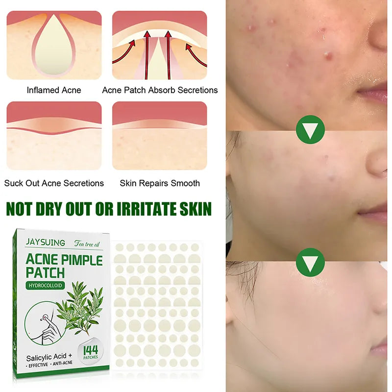 Quick Effect Acne Pimple Patch - Invisible Stickers for Face - 144 Patches - Beauty Skin Care Treatment